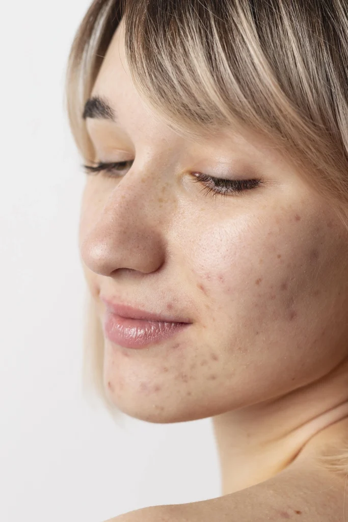 acné dermatología