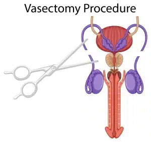 Cirugía vasectomía