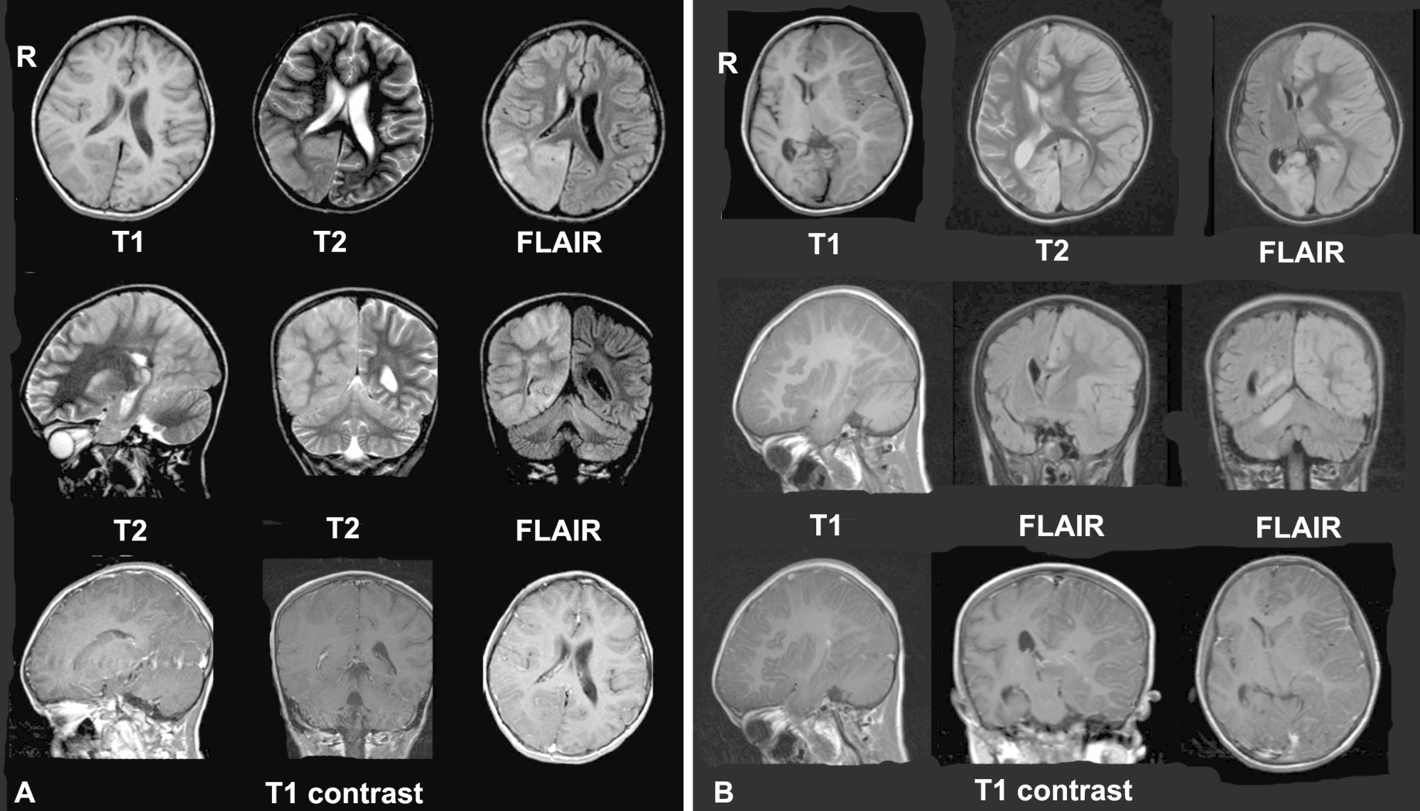 Se usa la teleradiología para diagnosticar una resonancia magnética de cerebro
