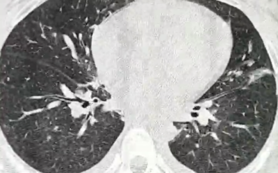 Tomografía computada de tórax de baja dosis en el diagnóstico de COVID-19