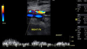 ultrasonido doppler