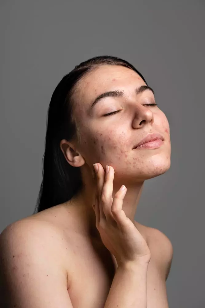 Tratamiento para el acné dermatología