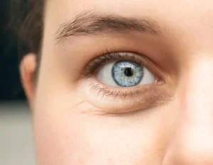 Ojeras Dermatología