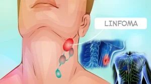 Linfoma de Hodgkins