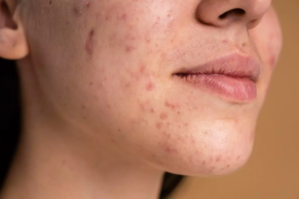 Tratamiento para el acné dermatología