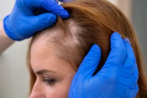 Dermatología Capilar