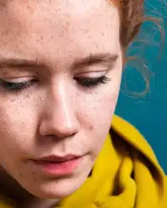 manchas en la cara dermatología