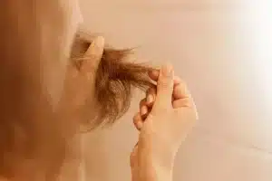 Dermatología Calvicie