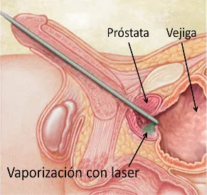 urología láser