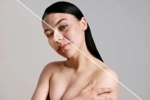acné dermatología