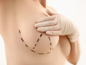 Cuidados después de una mamoplastia de aumento