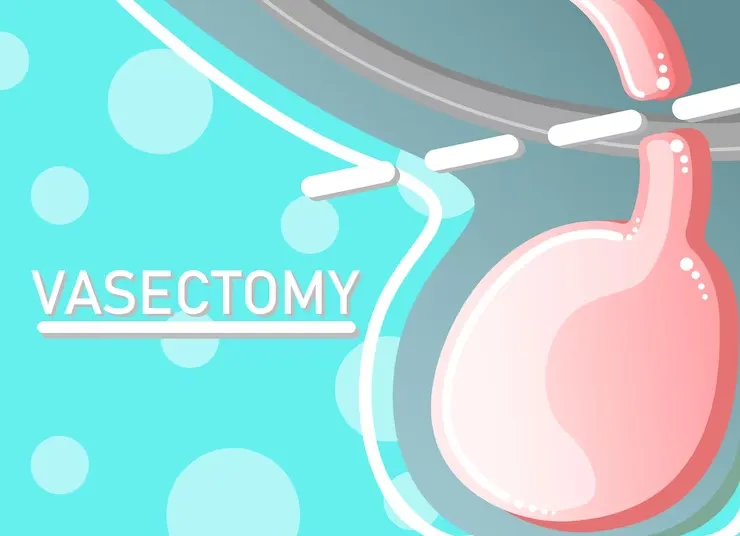 urología vasectomía