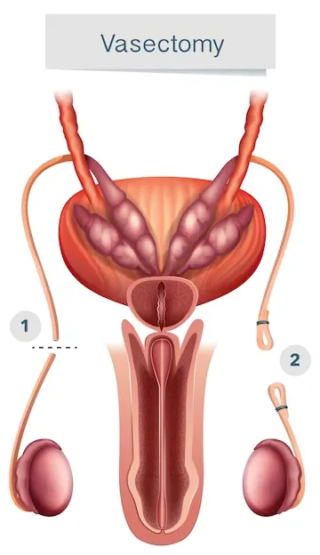 urología vasectomía