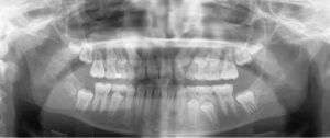 Radiografía dental de tipo panorámica